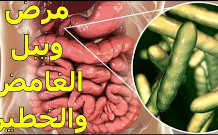 داء ويبل  " الحَثَل الشحمي المِعوي "