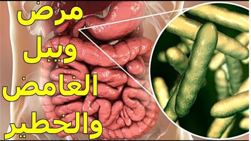 داء ويبل  " الحَثَل الشحمي المِعوي "