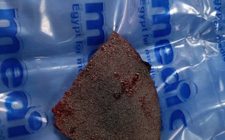 فريق طبي بـ مستشفي جامعة أسيوط ينجح في استخراج حجر صخري من وجه مريض