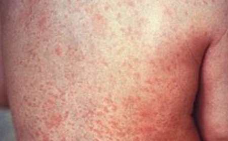 وباء فيروس بوحمرون يسيطر على المدارس و السجون فى المغرب 