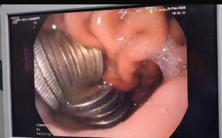 استخراج 13 جنيهًا معدنيًا من معدة شاب بالدقهلية