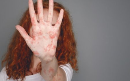 مضاعفات نادرة وقاتلة في فترة التعافي من الحصبة: جرس إنذار لأهمية التطعيم والمراقبة