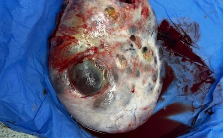 استئصال ورم ضخم بالمبيض يزن 7 كجم بمستشفى جامعة الأزهر بأسيوط